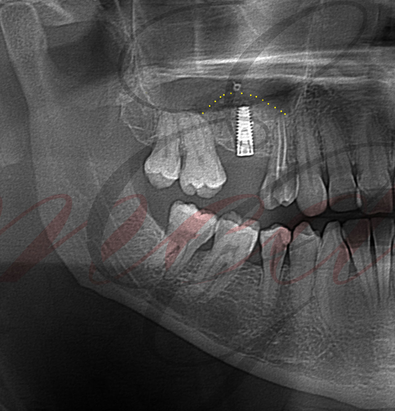 Lateral Lifting